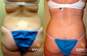 Before & After Photo