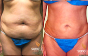 Before & After Photo