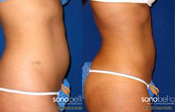 Before & After Photo