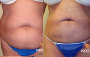Before & After Photo