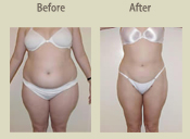 Before & After Photo