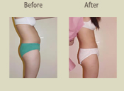 Before & After Photo