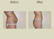 Before & After Photo