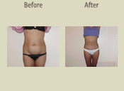 Before & After Photo