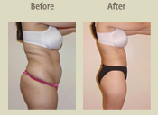 Before & After Photo