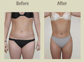 Before & After Photo