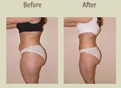 Before & After Photo