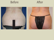 Before & After Photo