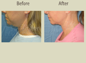 Before & After Photo