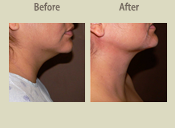 Before & After Photo