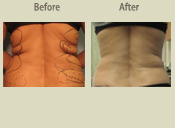 Before & After Photo
