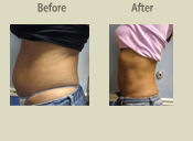 Before & After Photo