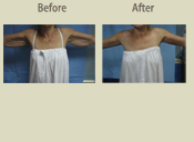 Before & After Photo