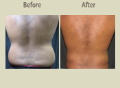Before & After Photo