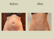 Before & After Photo