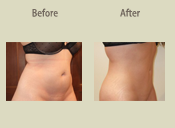 Before & After Photo