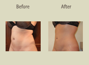 Before & After Photo