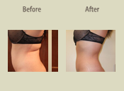 Before & After Photo