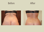 Before & After Photo