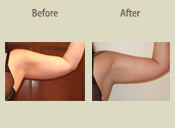 Before & After Photo