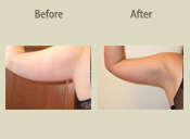 Before & After Photo