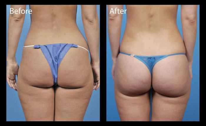 Before & After Photo