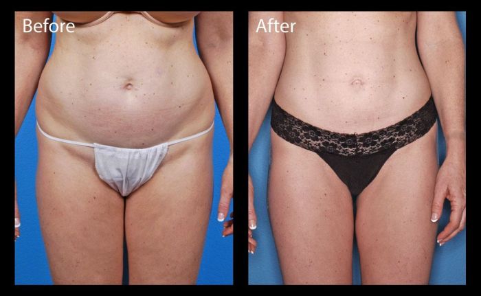 Before & After Photo