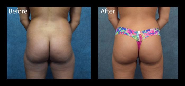 Before & After Photo