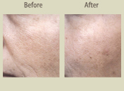 Before & After Photo