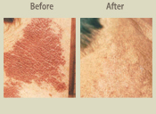 Before & After Photo
