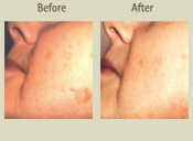 Before & After Photo