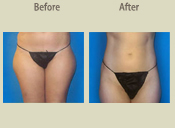 Before & After Photo