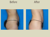 Before & After Photo