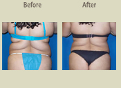 Before & After Photo