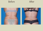 Before & After Photo