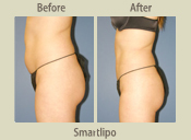 Before & After Photo