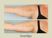 Before & After Photo