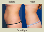 Before & After Photo