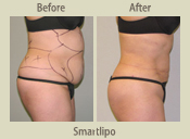 Before & After Photo