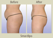 Before & After Photo