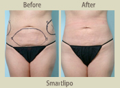 Before & After Photo