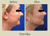 Before & After Photo