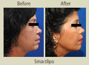 Before & After Photo