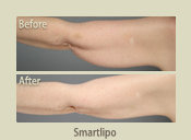 Before & After Photo
