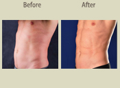 Before & After Photo