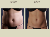 Before & After Photo