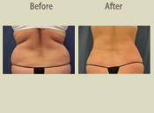 Before & After Photo