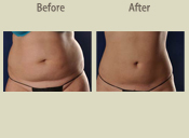Before & After Photo