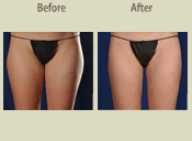 Before & After Photo