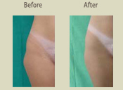 Before & After Photo